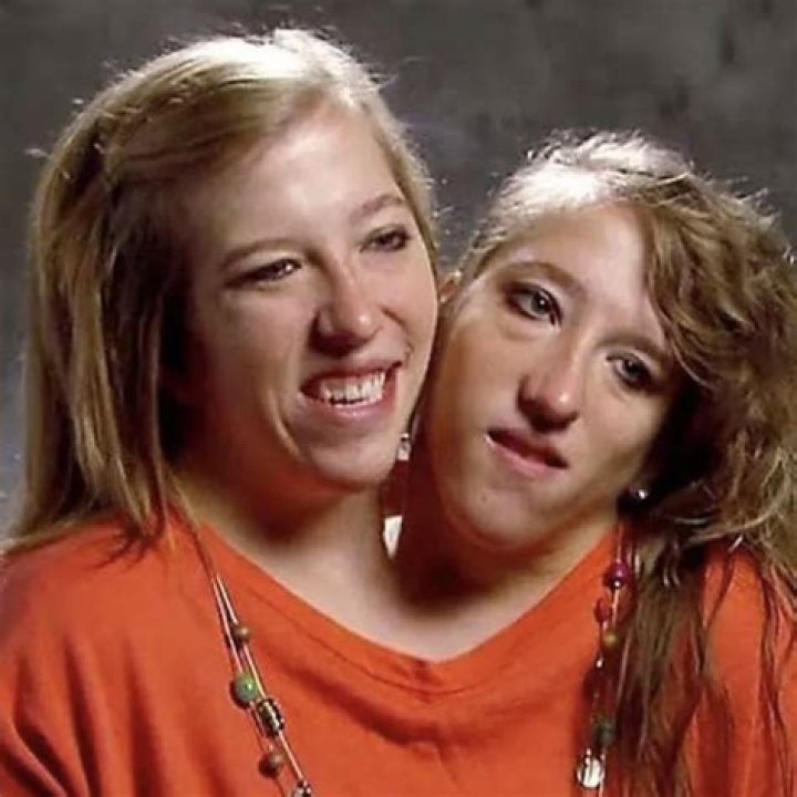 Brittney Hensel: The Inspiring Life of a Conjoined Twin