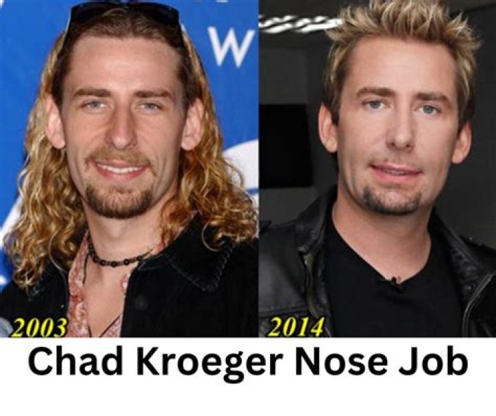 Chad Kroeger Nose Job: The Transformation of a Rock Star