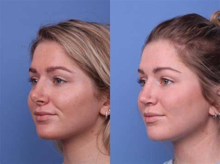 Trey Gowdy's Nose Transformation: A Closer Look at the Before and After