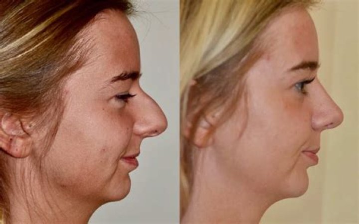 Trey Gowdy: A Closer Look at His Nose Before and After
